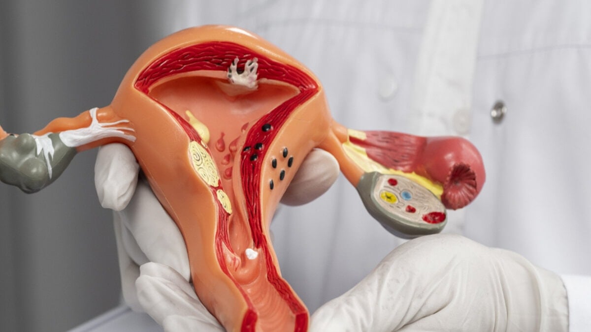 Polikistik over sendromunuz varsa bu gıdaları tüketmeden geçmeyin!