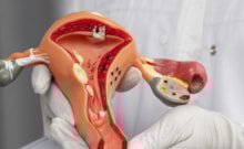 Polikistik over sendromunuz varsa bu gıdaları tüketmeden geçmeyin!