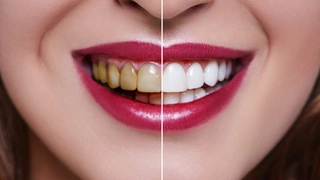 Sağlıklı ve beyaz dişler: Etkili beyazlatma teknikleri
